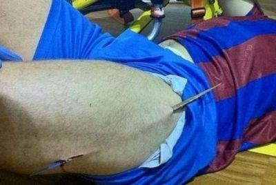 
	Toata Barcelona a inlemnit! Un fotbalist s-a ales cu o aschie de jumatate de metru in picior! Vezi ce s-a intamplat:
