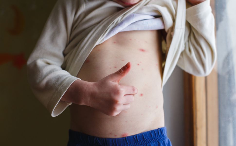 Dureri articulare varicelă, Varicela: Cauze, Simptome & Tratament