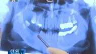 V-ati facut recent un implant dentar si nu sunteti multumiti de aspectul estetic al gingiei?