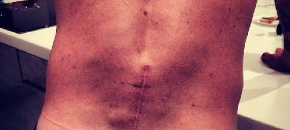 <span style="color:#f00;">Foto socant: S-a operat de urgenta dupa ce a patit asta! </span>Cum arata spatele unuia dintre cei mai mari sportivi ai lumii
