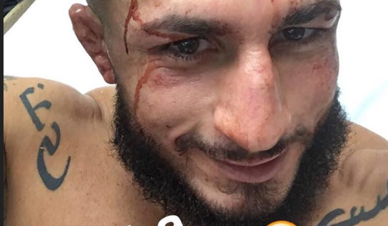 <span style="color:#f00;">"Nu o sa isi mai faca niciodata freza la fel!" </span>:) INCREDIBIL! Ce a patit acest luptator la debutul in UFC! FOTO SOCANT