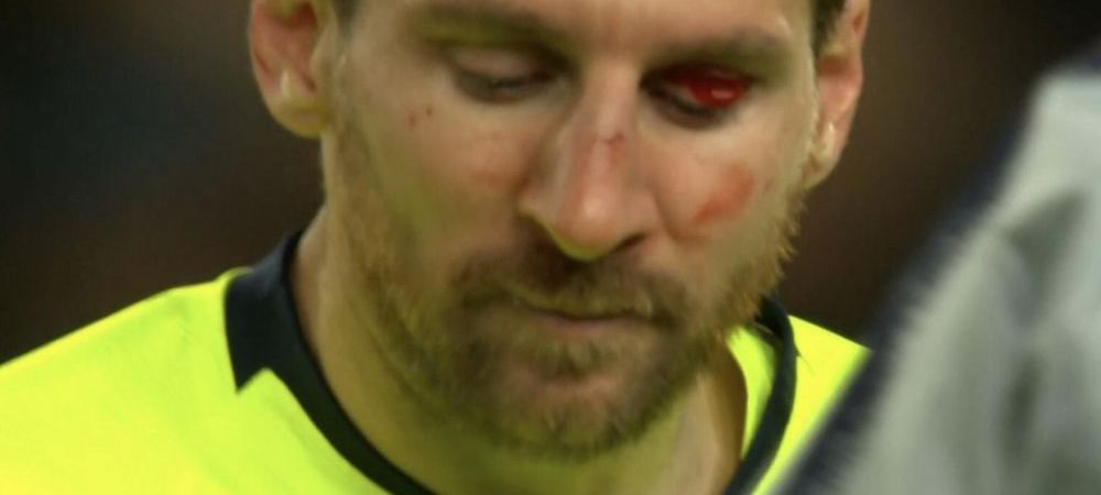 Messi intra in laborator! <span style="color:#f00;">Medicii se tem ca are fractura dupa ce a fost UMPLUT de sange la Manchester</span>