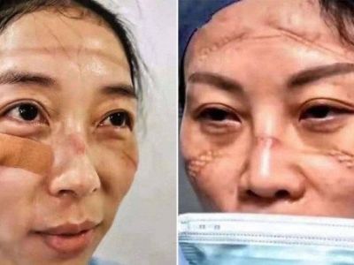 Imagini Socante Medicii Care Ii Trateaza Pe Chinezi De Coronavirus Desfigurati De La Echipamentul De Protectie Sunt Epuizati Sport Ro