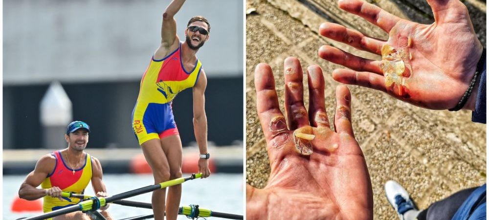 
	Suferințele din spatele unei medalii olimpice | Poza cu palmele lui Ciprian Tudosă, dovada sacrificiilor uriașe
